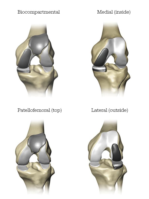 Diagram showing four types of partial knee replacements. Top left: Biocompartmental knee replacement covering two compartments. Top right: Medial (inside) knee replacement showing implant on the inner side of the knee joint. Bottom left: Patellofemoral (top) knee replacement showing implant on the front of the knee between the kneecap and femur. Bottom right: Lateral (outside) knee replacement showing implant on the outer side of the knee joint.