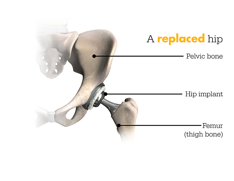 Medical illustration of a replaced hip joint. The image labels the pelvic bone, femur (thigh bone), and the replaced hip implant where the hip joint meets. The title reads ‘A replaced hip,' with the word ‘replaced' highlighted in orange.